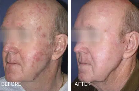 ProFractional before and after photos at Boulder Valley Laser & Cosmetic
