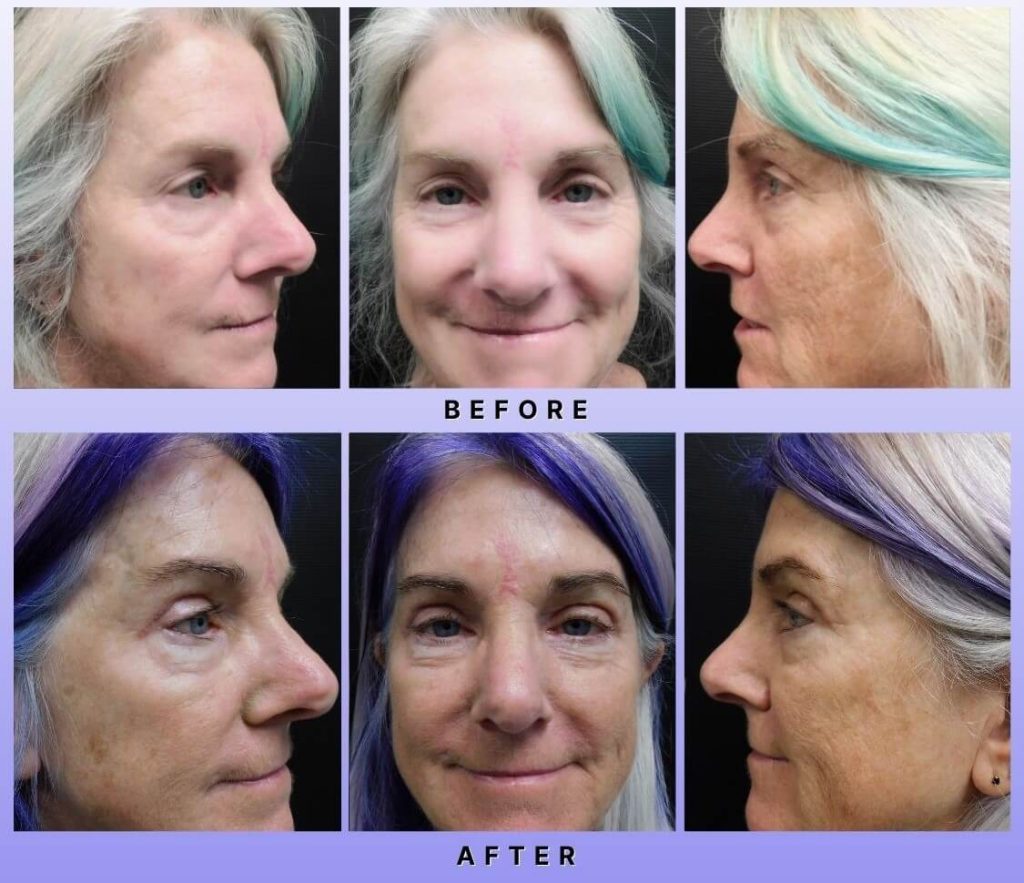 Blepharoplasty Before and After