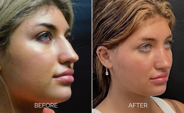 Rhinoplasty before and after right sideview in 45 degrees showing an enhanced nose appearance.