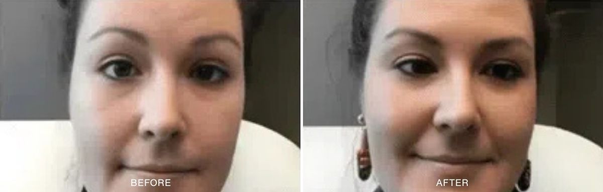 Botox before and after images