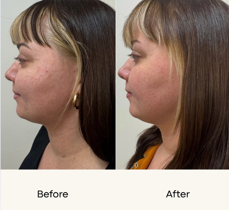 Skinvive Before-and-after results at Boulder Valley Laser & Cosmetic